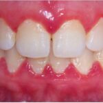 gum disease unitymissiondentalclinic