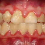 gum disease unitymissiondentalclinic
