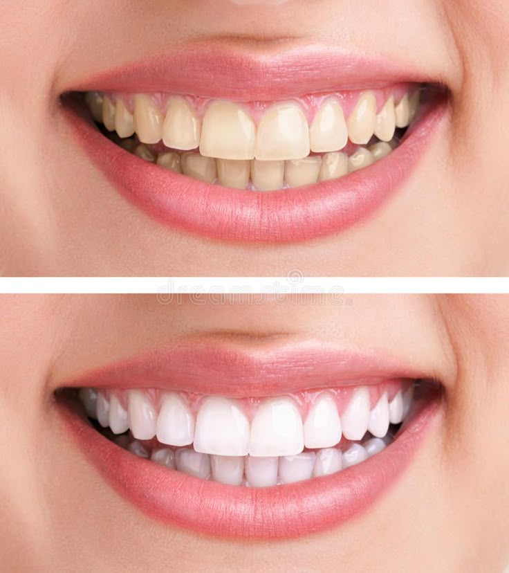 teeth whitening unitymissiondentalclinic