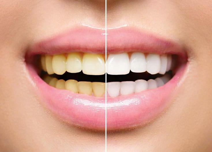 teeth whitening unitymissiondentalclinic