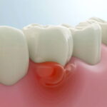 gum disease unitymissiondentalclinic