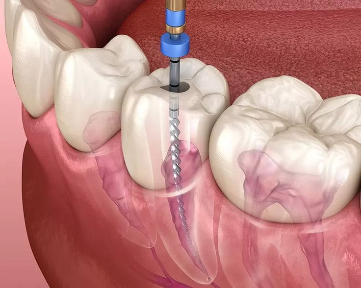 root canal treatment unitymissiondentalclinic