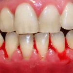 gum disease unitymissiondentalclinic
