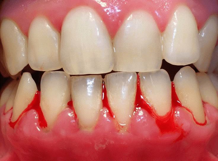 gum disease unitymissiondentalclinic